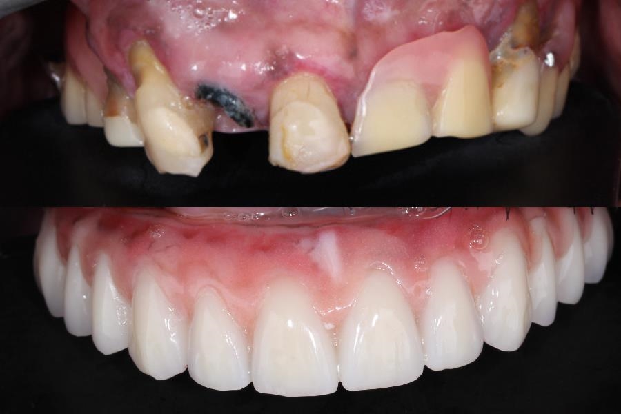 Protocolo Em Resina Transformando Sorrisos Est Tica Dent Ria Avan Ada